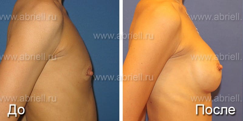 До и после протезирования груди вид сбоку