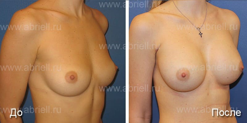 Протезирование груди круглыми имплантами со средним профилем