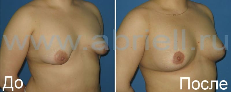 Липофиллинг груди. У пациентки табулярная грудь: ложный птоз II-III степен