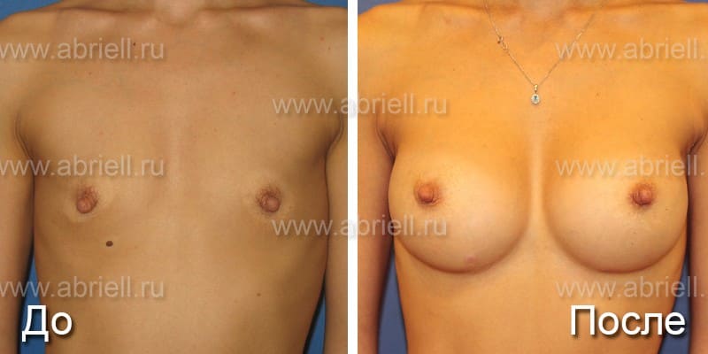 До и после протезирования груди вид спереди