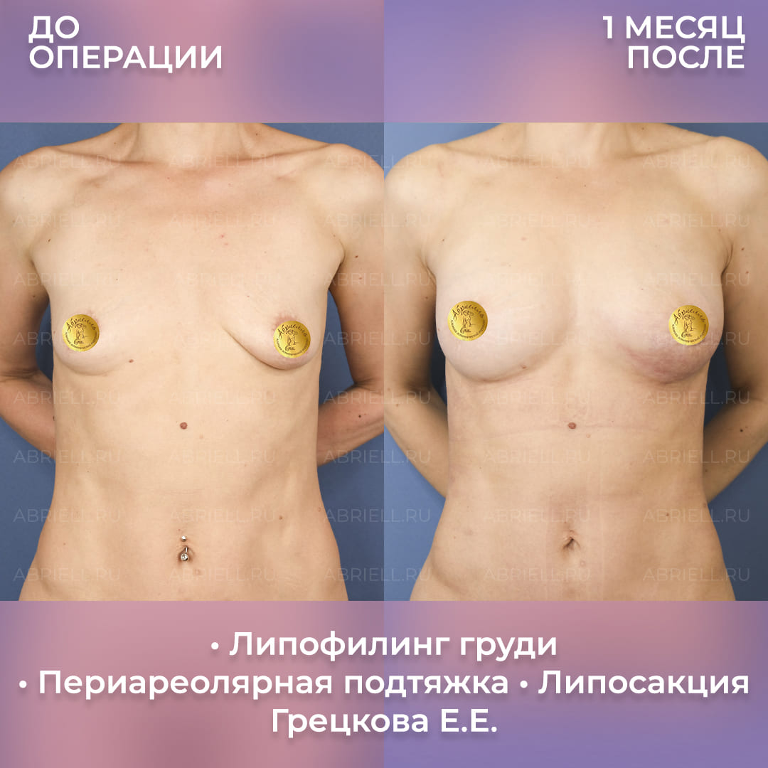Фото увеличения груди без имплантов