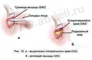 Резекция мышцы DAO