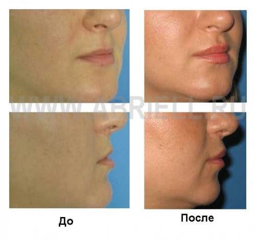 Фото «до и после» операции V-Y пластики верхней губы