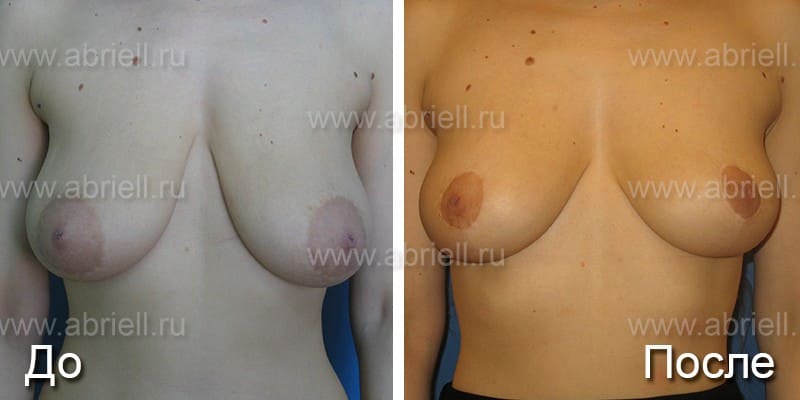 Операция на грудь фото