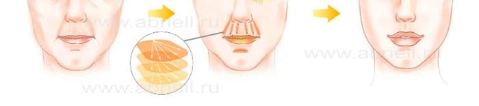Липофилинг губ