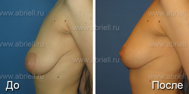 Операция на грудь фото