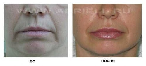 Фото «до и после» омоложения рта
