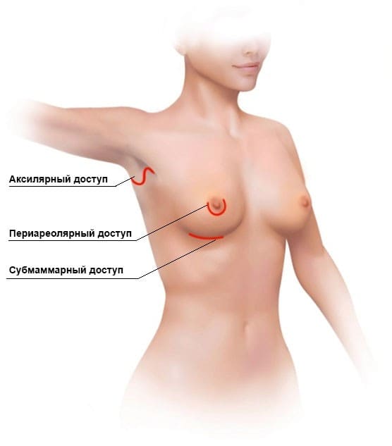 Способы увеличения груди