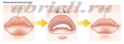 Уменьшение объема губ