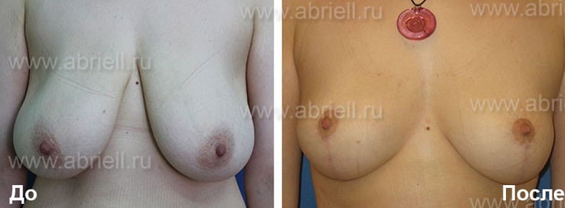 Диета для уменьшения грудных желез у женщин
