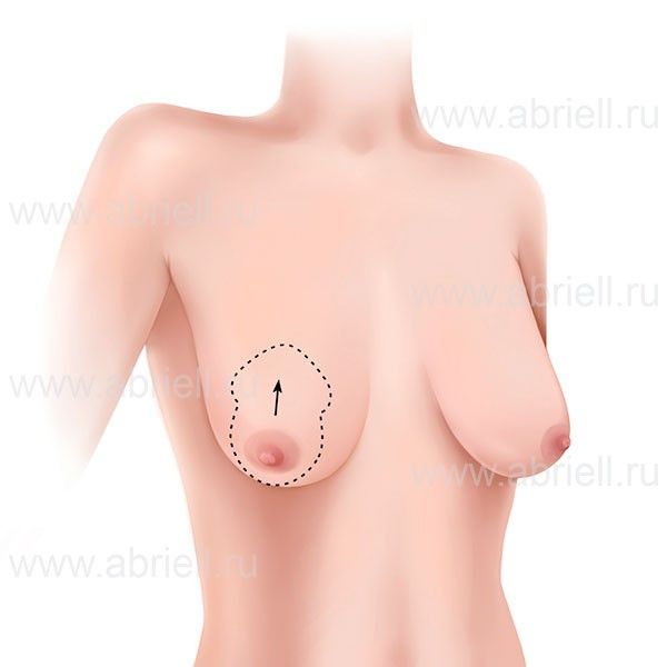 Уменьшение грудных желез