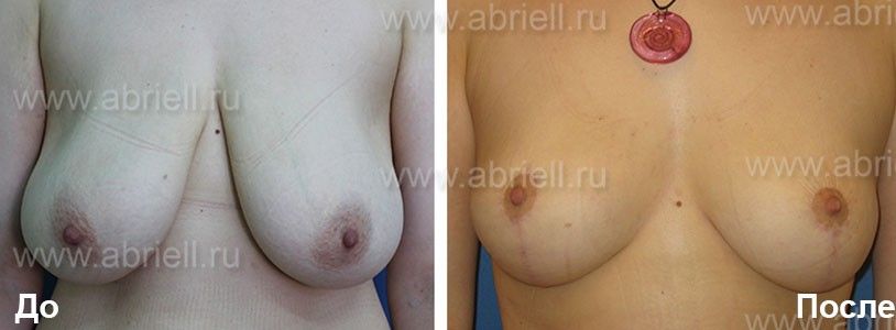 Уменьшение грудных желез фото