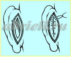 Коррекция ушных раковин