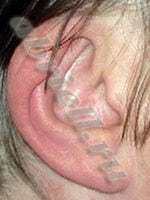 Коррекция ушных раковин