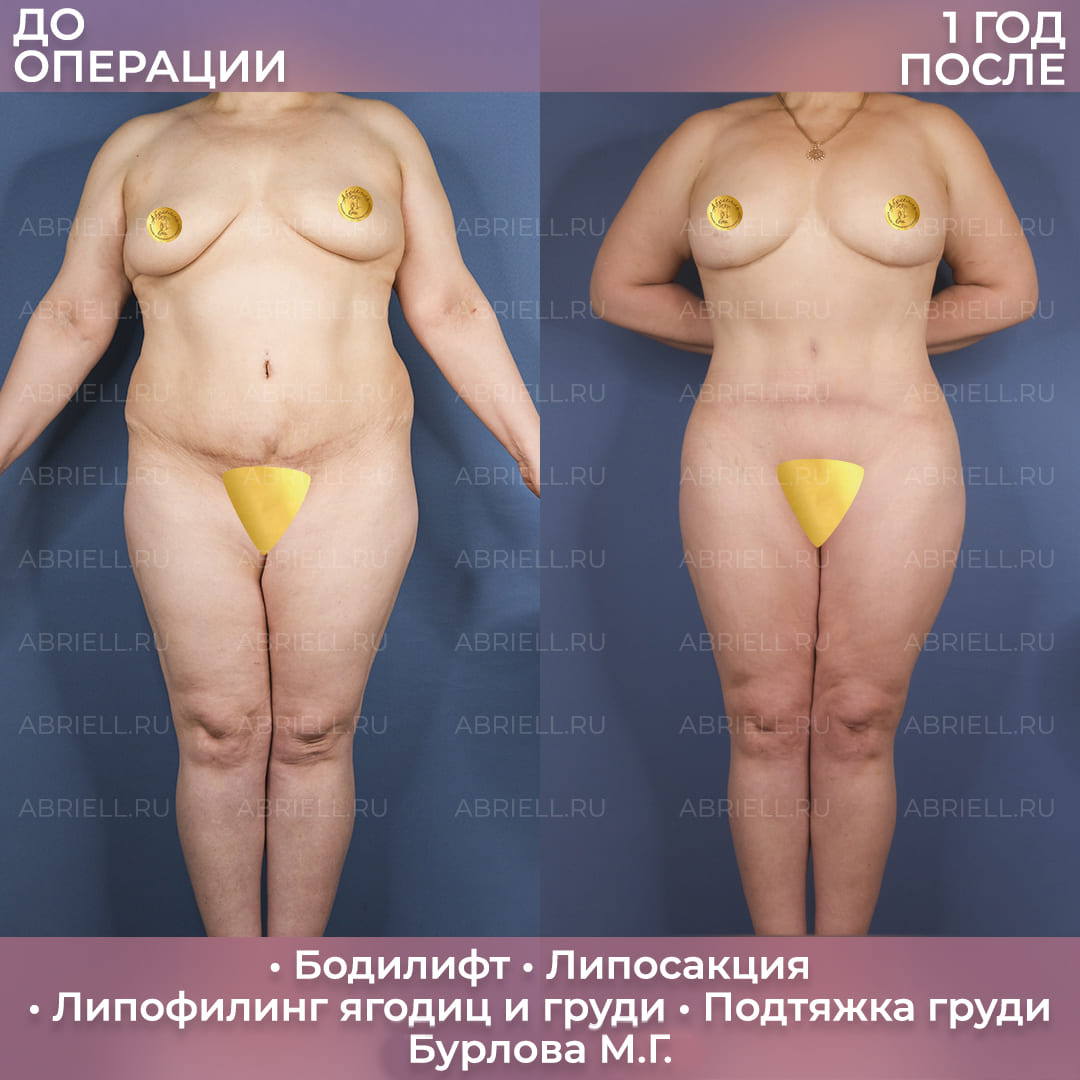 Бодилифт и коррекция контуров