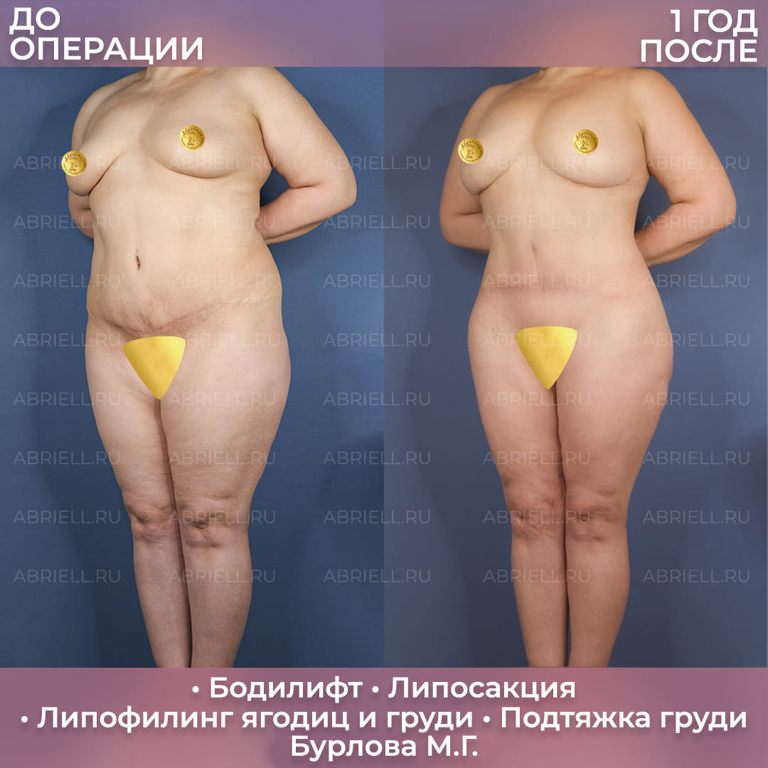 Бодилифт и коррекция контуров