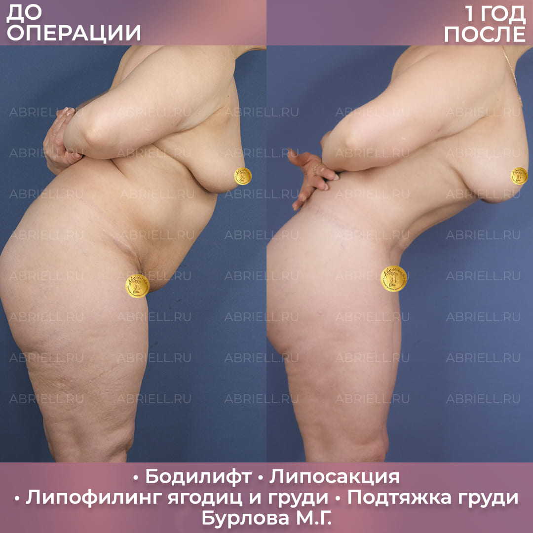 Бодилифт и коррекция контуров