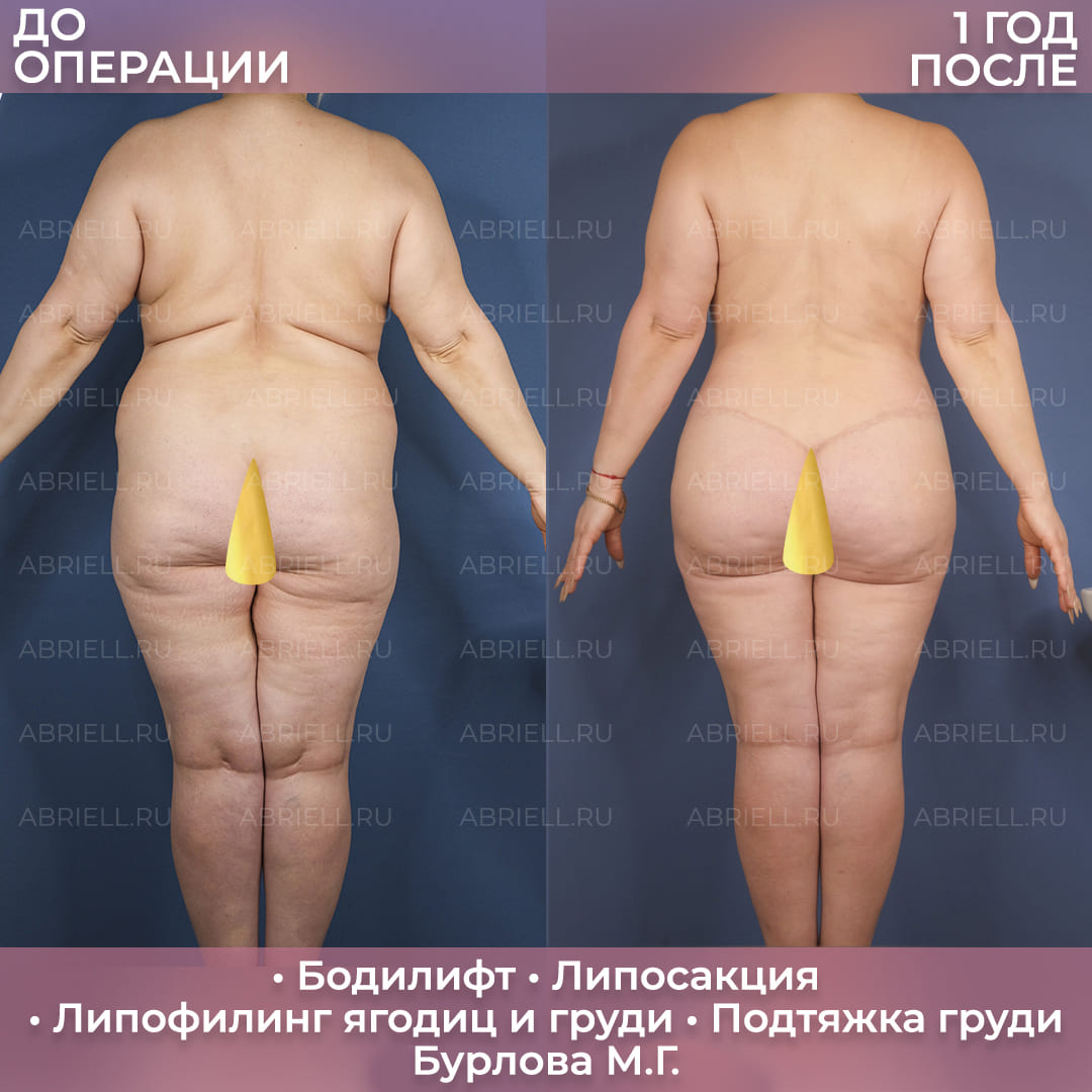 Бодилифт и коррекция контуров