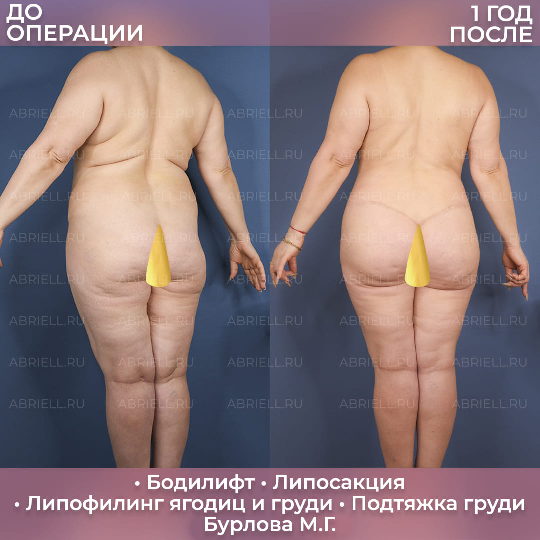 Бодилифт и коррекция контуров
