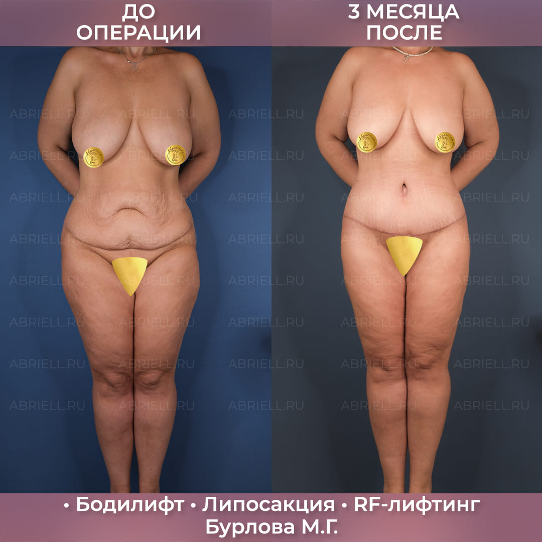 Бодилифт с RF-лифтингом