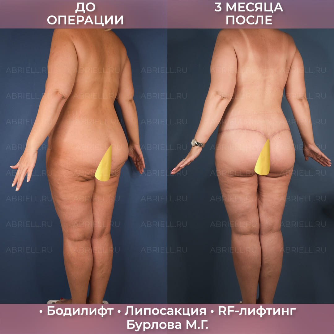 Бодилифт с RF-лифтингом