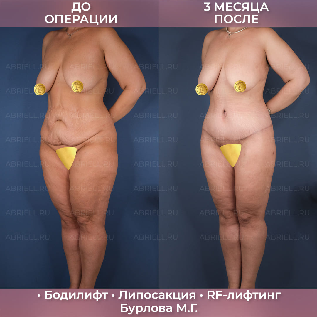 Бодилифт с RF-лифтингом