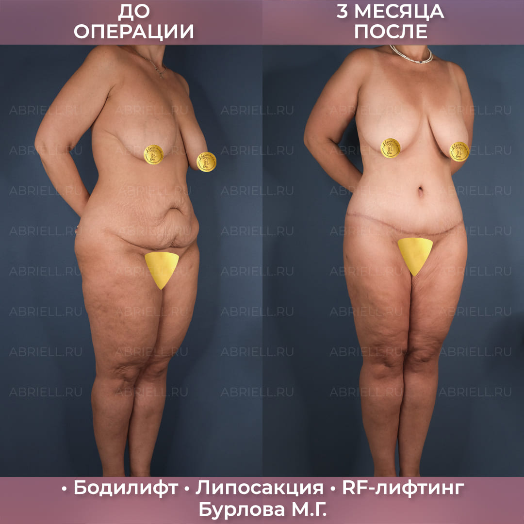 Бодилифт с RF-лифтингом