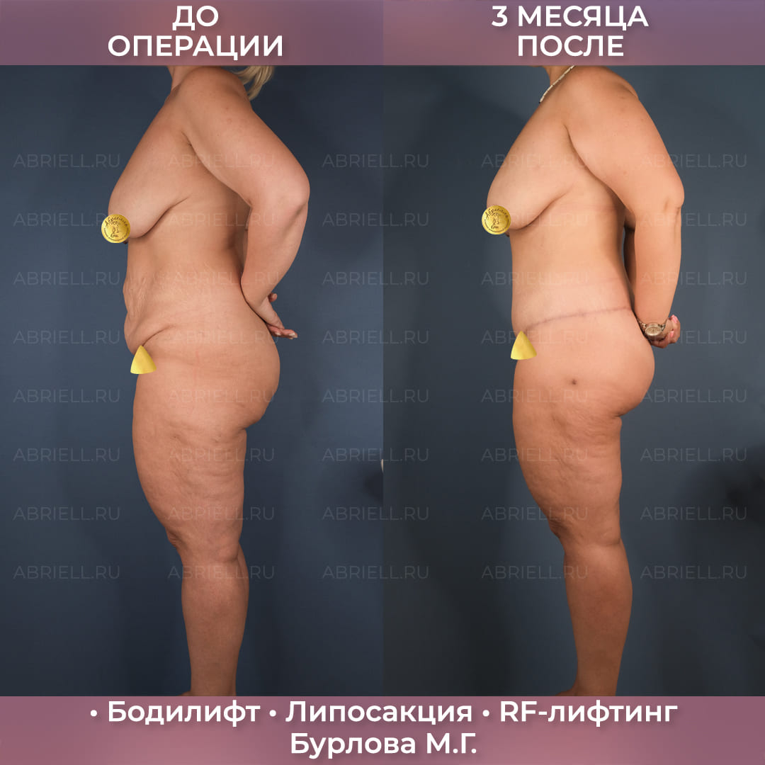 Бодилифт с RF-лифтингом