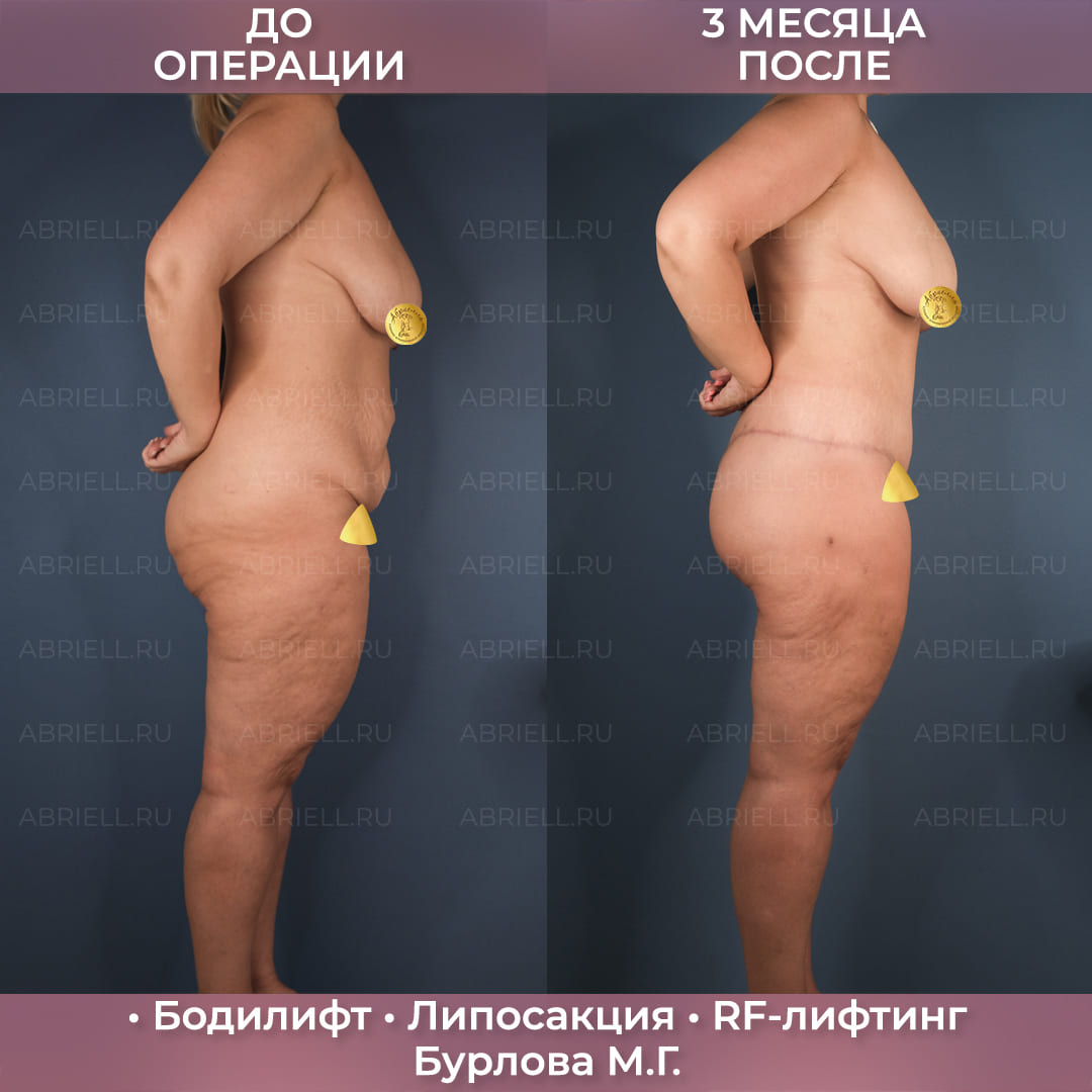 Бодилифт с RF-лифтингом
