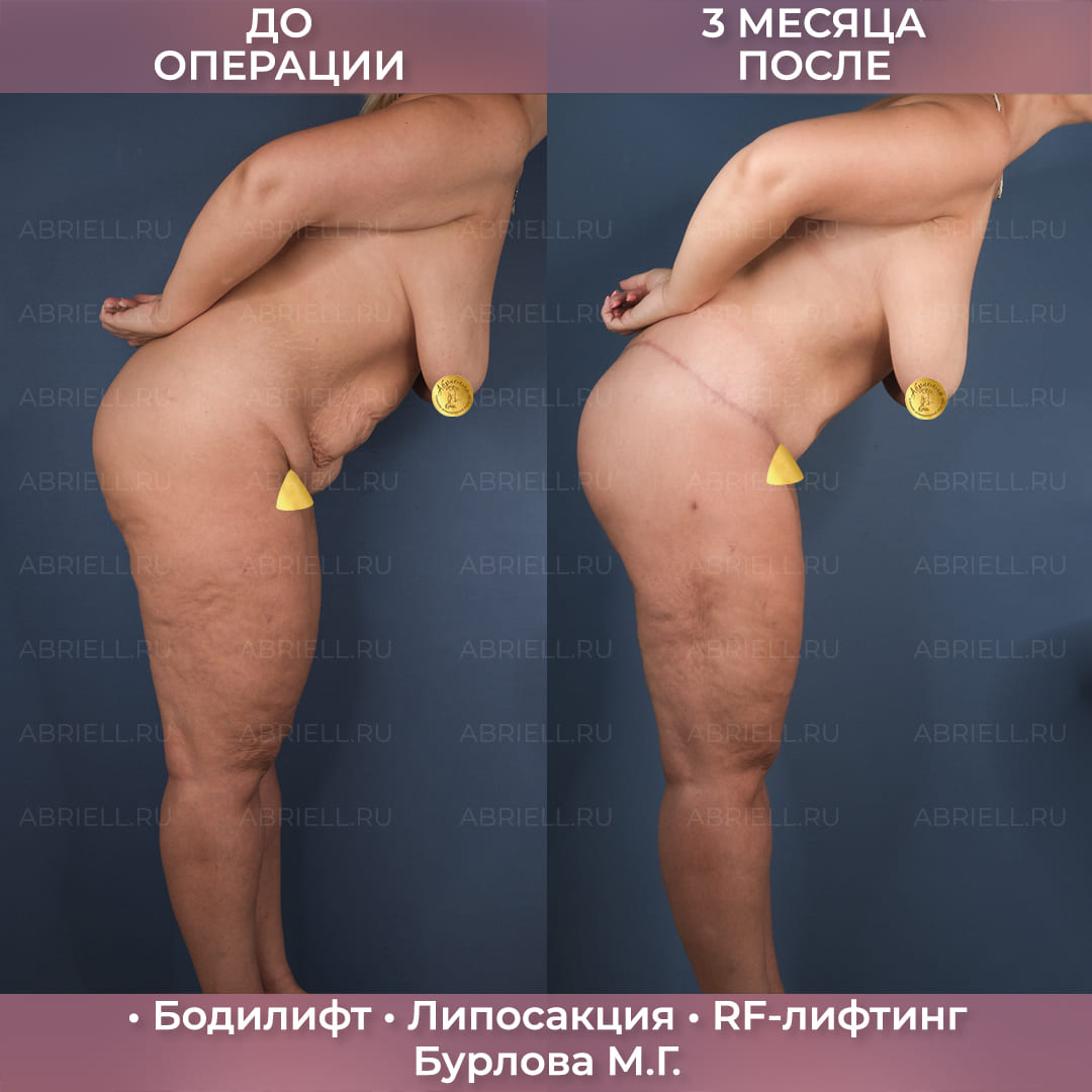 Бодилифт с RF-лифтингом