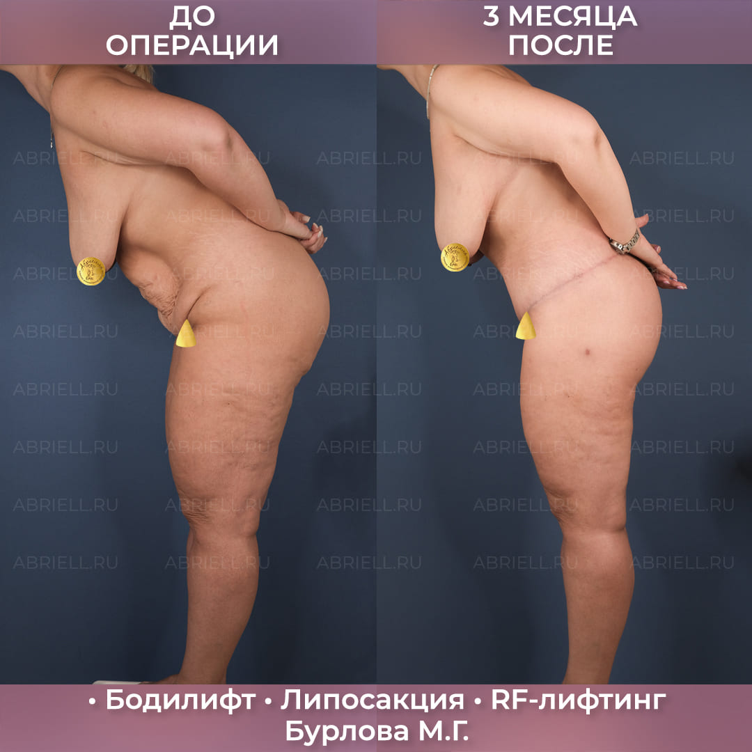 Бодилифт с RF-лифтингом