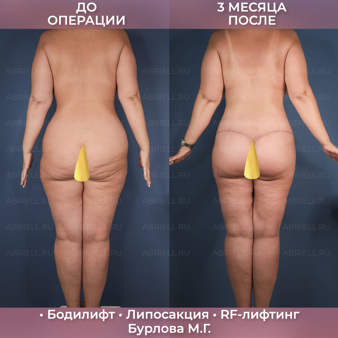 Бодилифт с RF-лифтингом