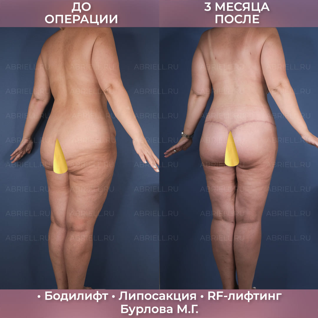 Бодилифт с RF-лифтингом