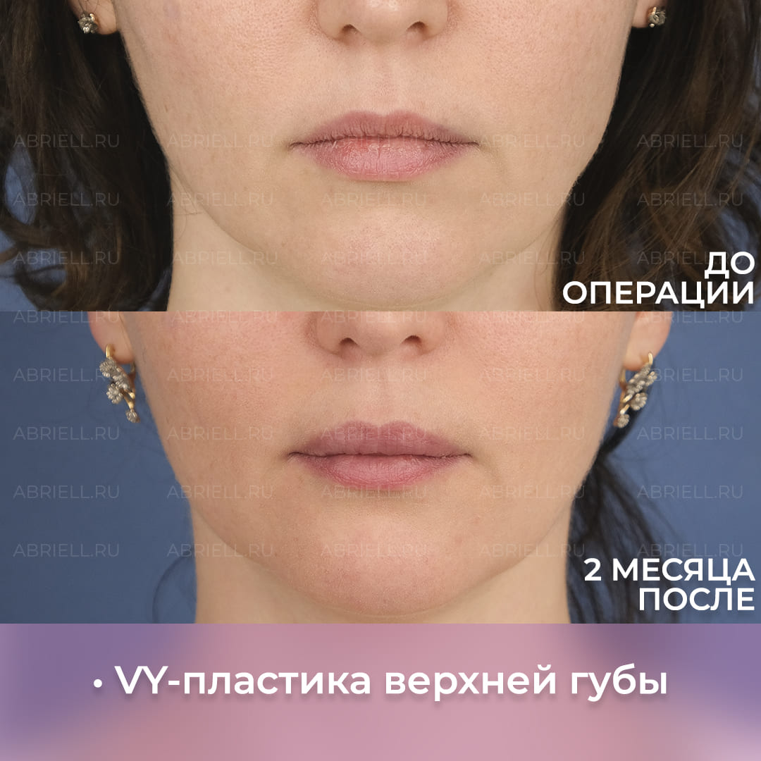 До и после хейлопластики губ