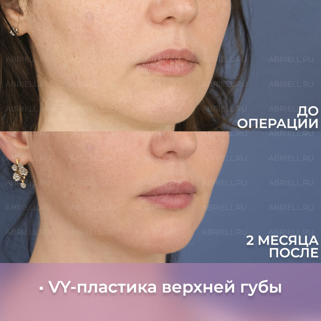 Фото до и после хейлопластики губ