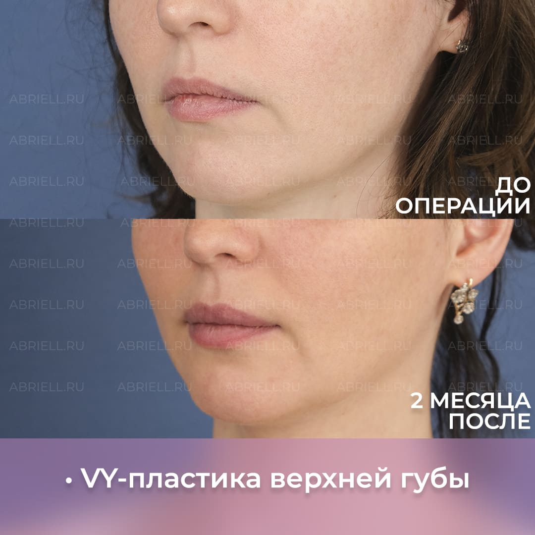 До и после хейлопластики губ