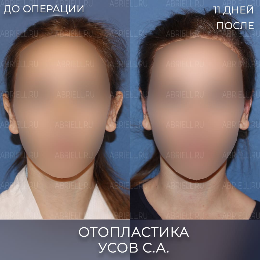 До и после операции на ушах