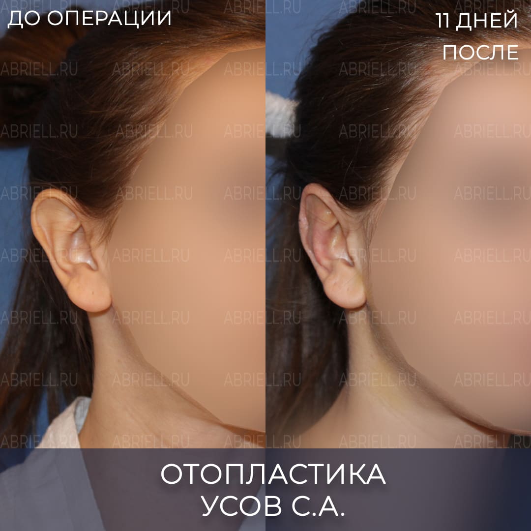 До и после коррекции ушей операцией