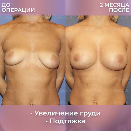 Фото до и после эндопротезирования груди