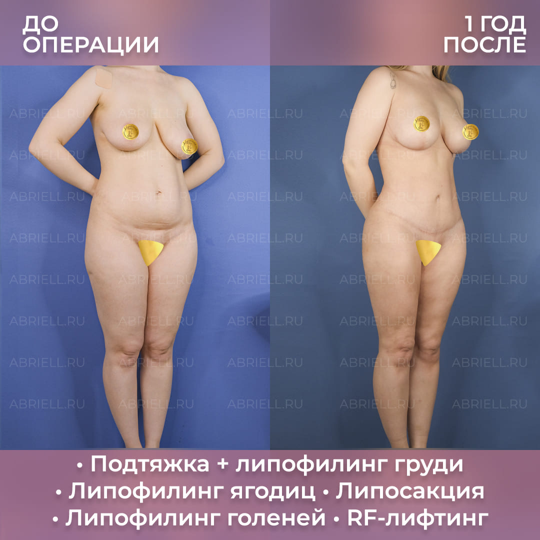 Фото до и после увеличения голеней собственным жиром