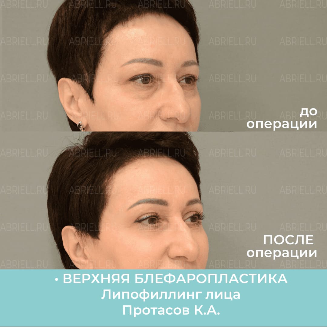 Фото до и после липофилинга лица