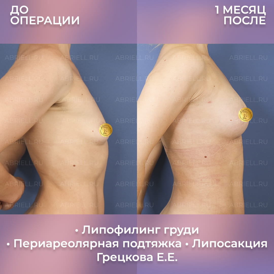 Результат перед и после подтяжки груди