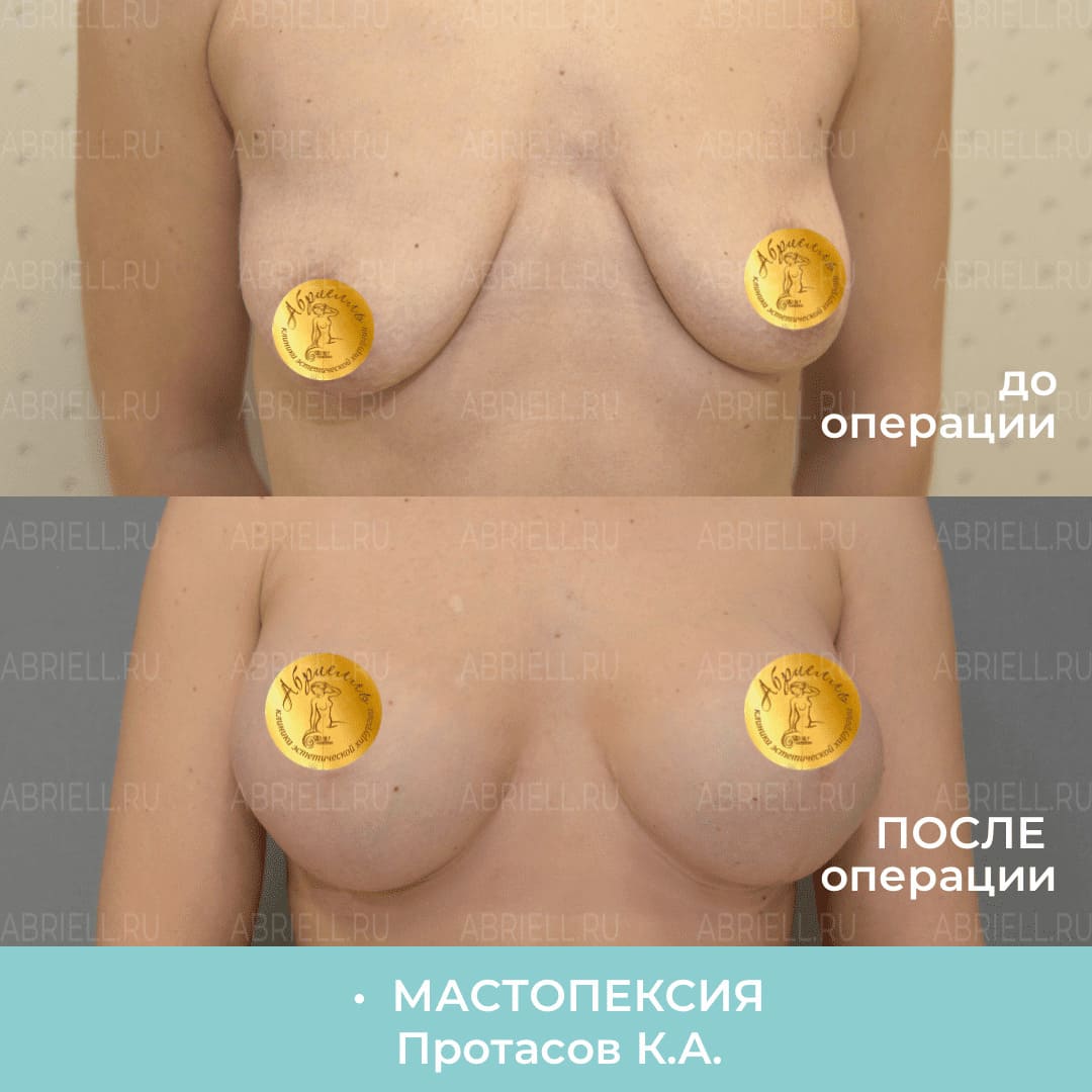 Фото до и после подтяжки груди