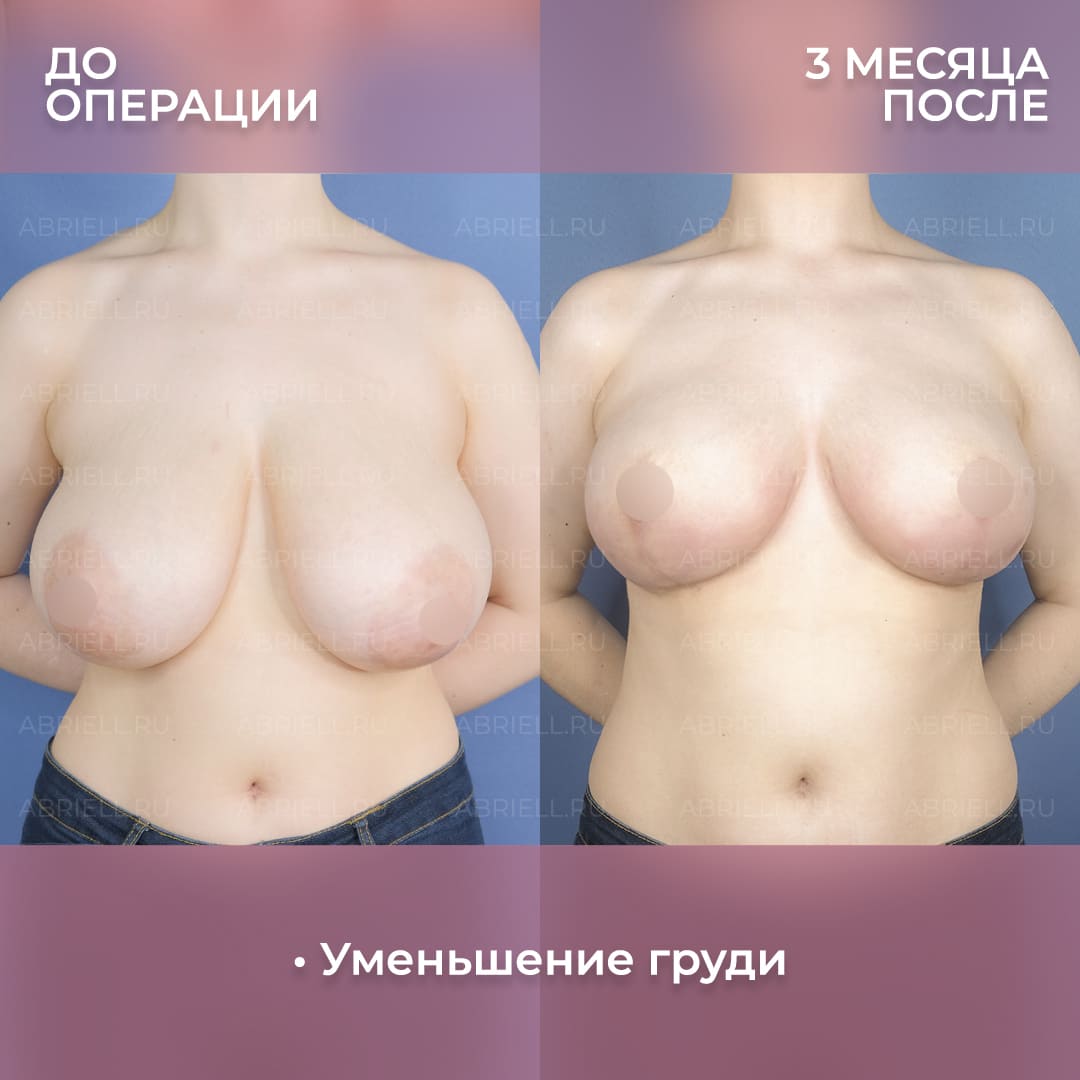 Фото до и после уменьшения груди