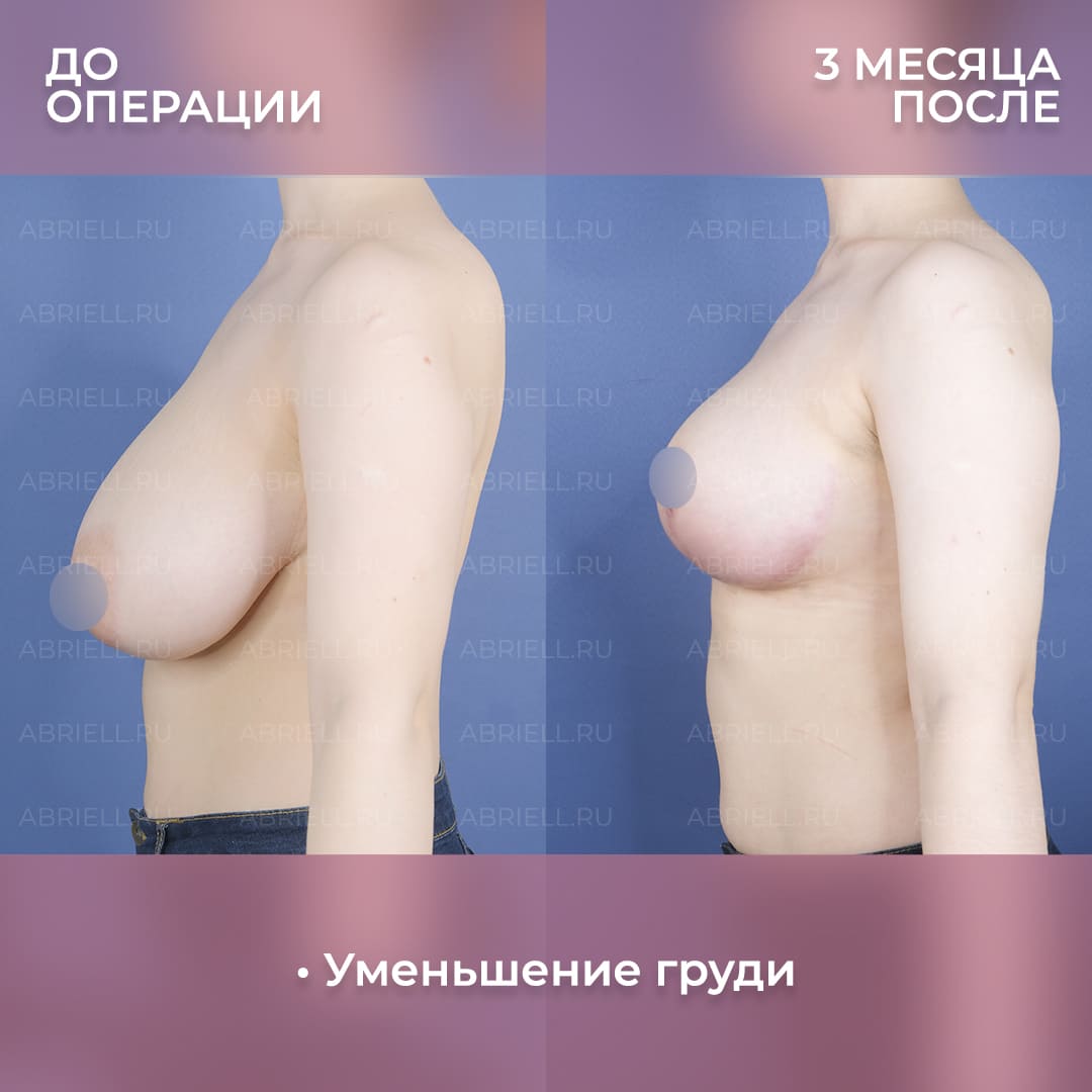 До и после уменьшения груди