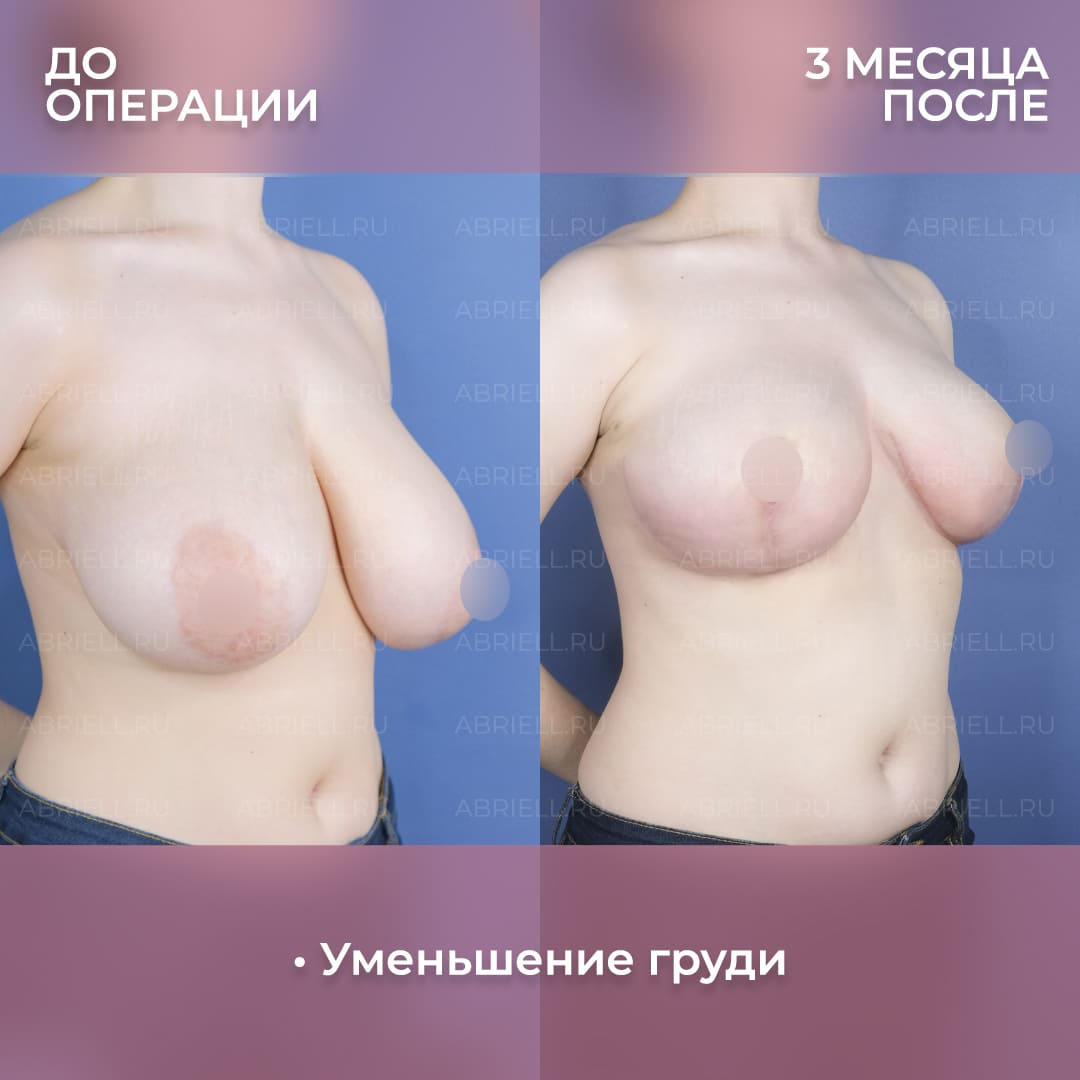 Фотографии до и после уменьшения груди