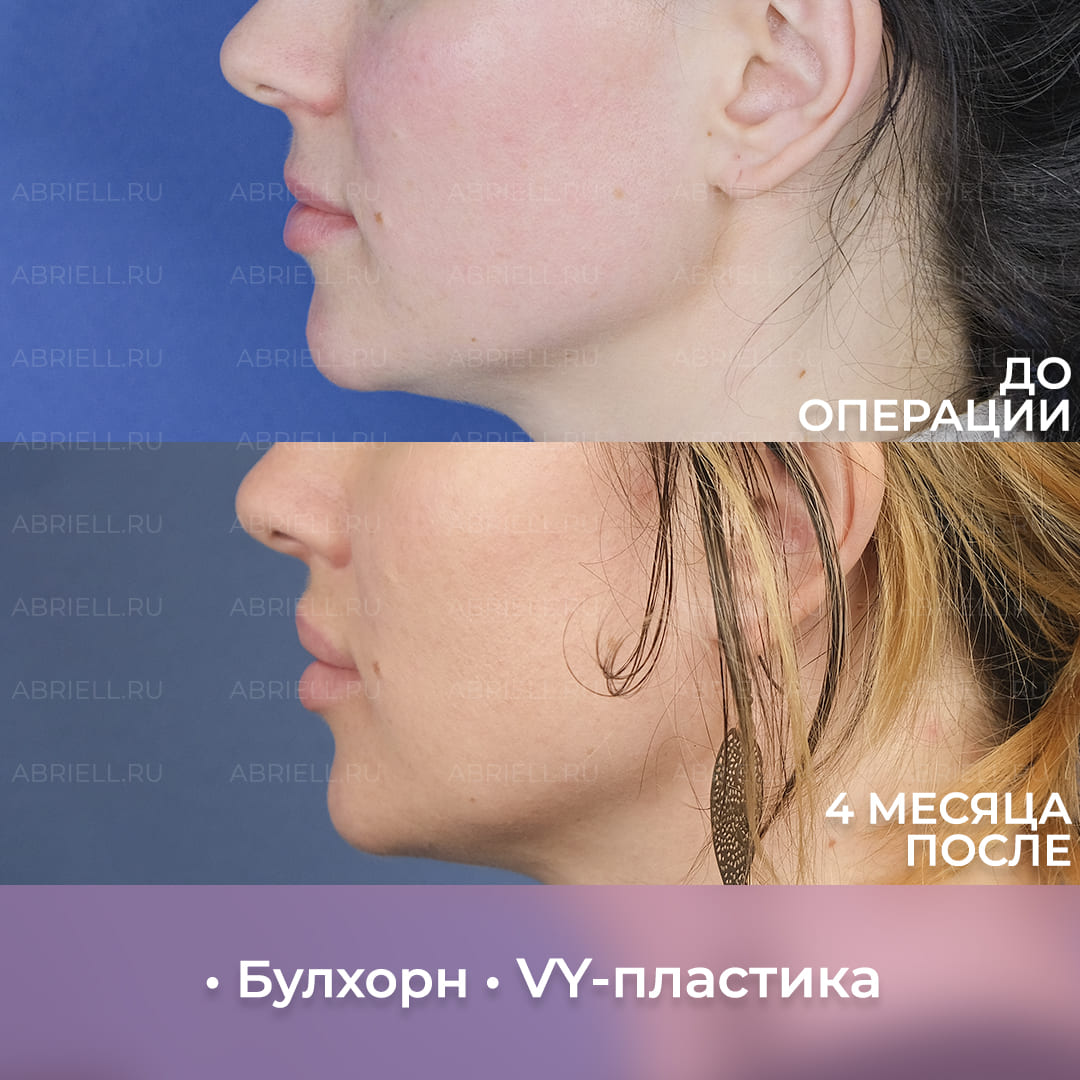 Результаты хейлопластики губ в Санкт-Петербурге