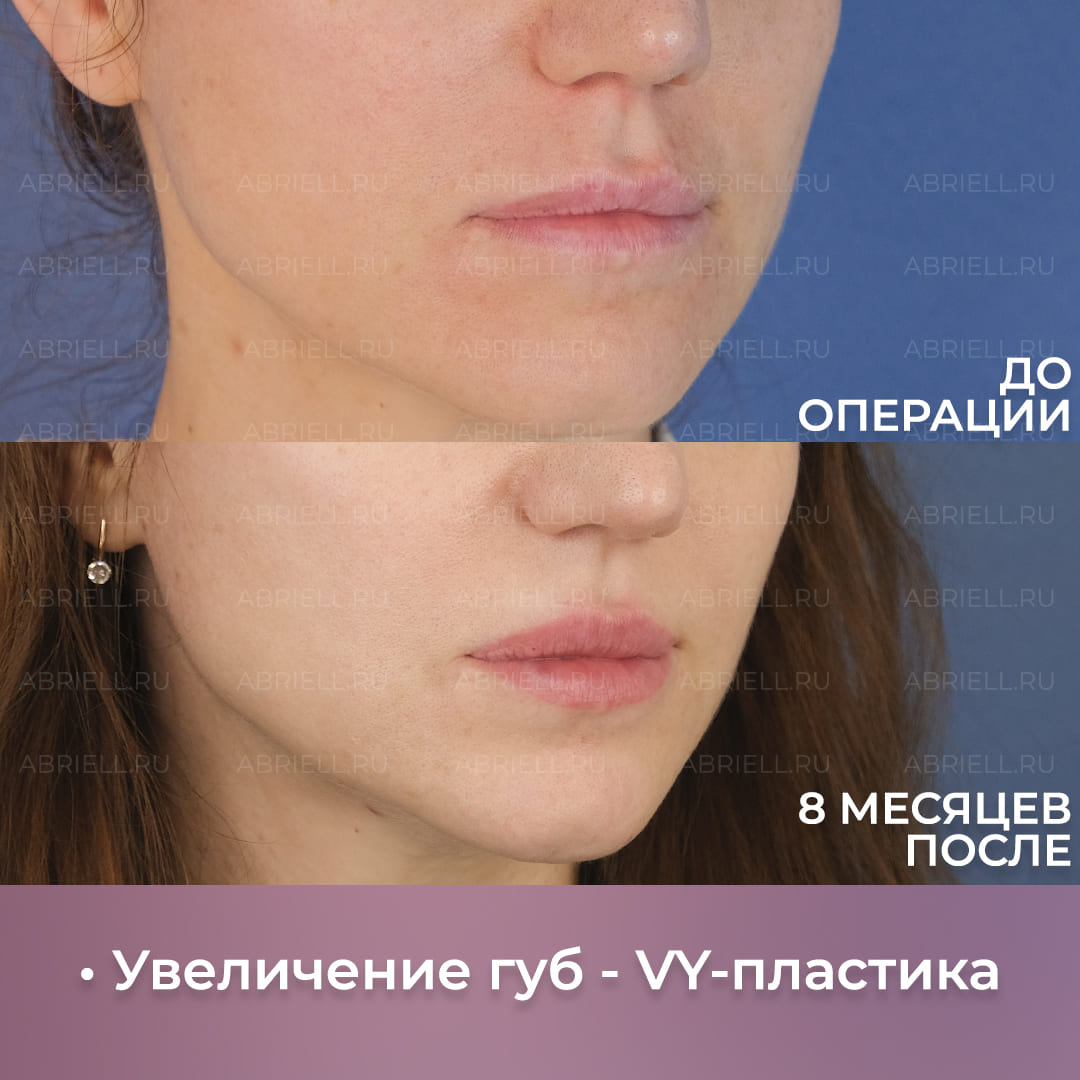Фотография результатов коррекции губ хейлопластикой