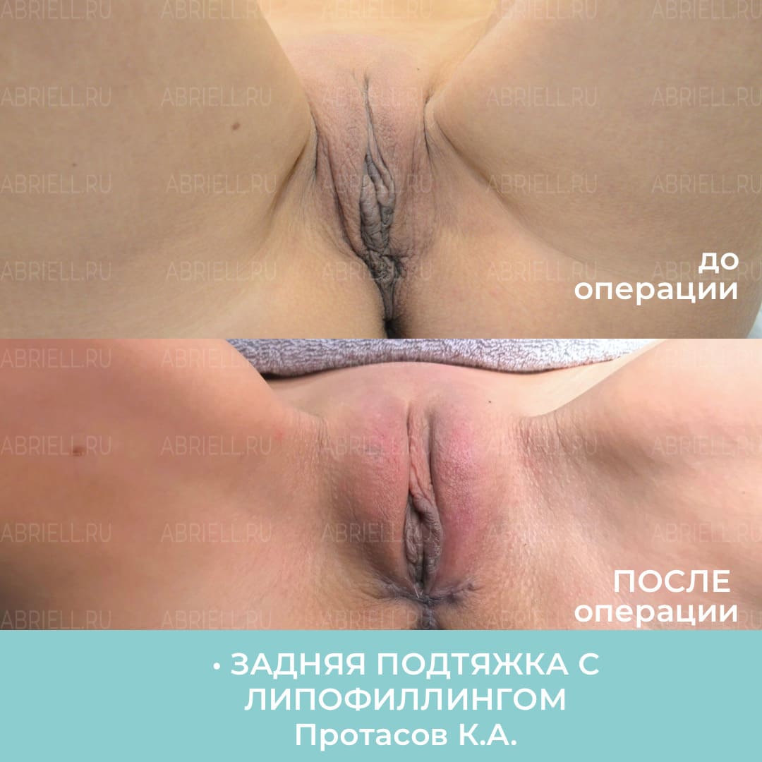 До и после увеличения половых губ