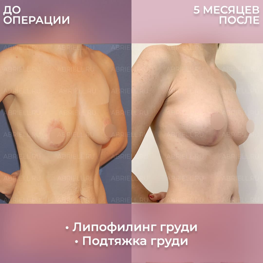 отзывы женщин о подтяжке груди фото 7